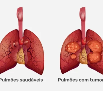Sintomas de cancer de pulmao 28025 360x320